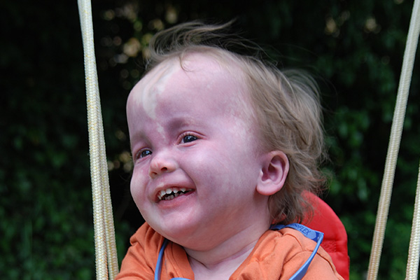 A young boy with light brown hair is sat on a swing, he is looking up at someone and has a big smile on his face which is predominately covered by a port wine birthmark. he is wearing an orange t shirt